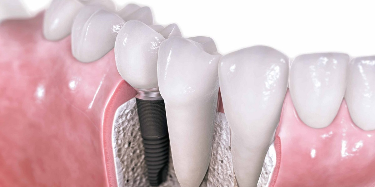 چسب دندان ایمپلنت چیست؟